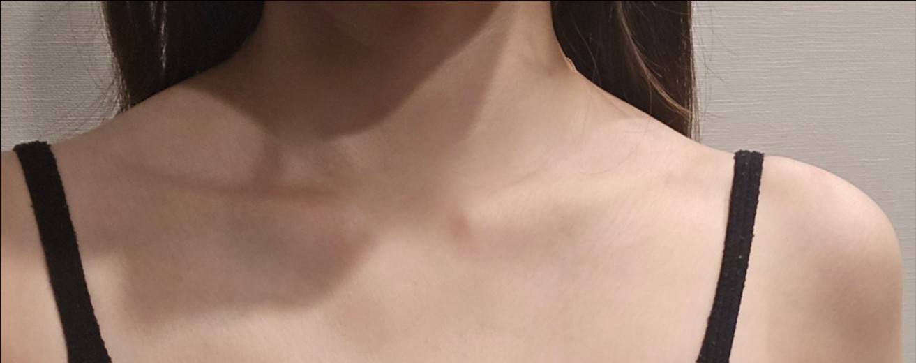 after photo: 肩ボトックス(僧帽筋)