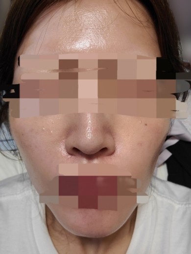 after photo: ハイドラフェイシャル, 診断・検査