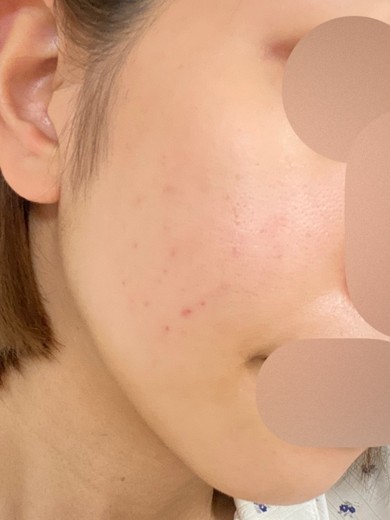 after photo: IPL(光/フォト治療)