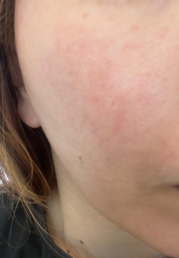 before photo: ピーリング, ルメッカ