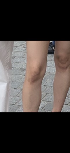 before photo: 종아리보톡스