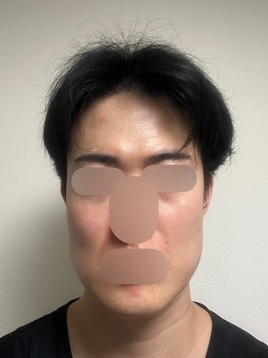 after photo: エレクトロポレーション