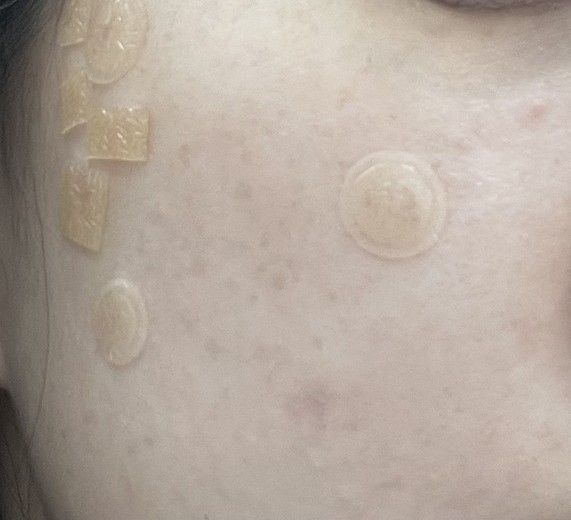 after photo: CO2레이저, 비립종제거, 사마귀제거