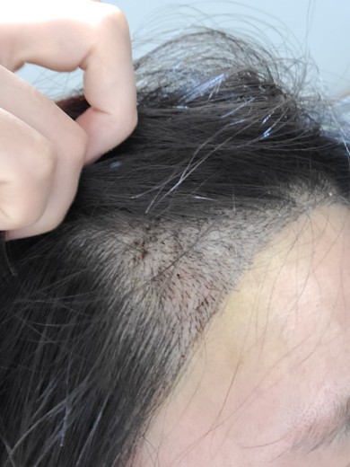 after photo: 머리모발이식