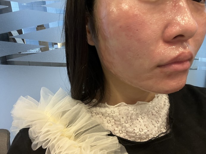 after photo: エレクトロポレーション
