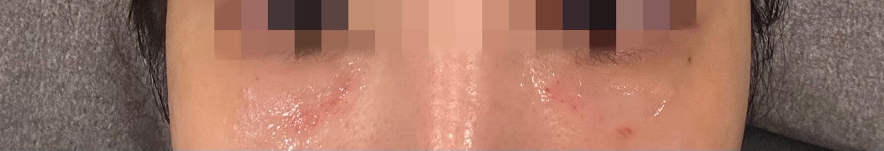 after photo: 눈밑필러