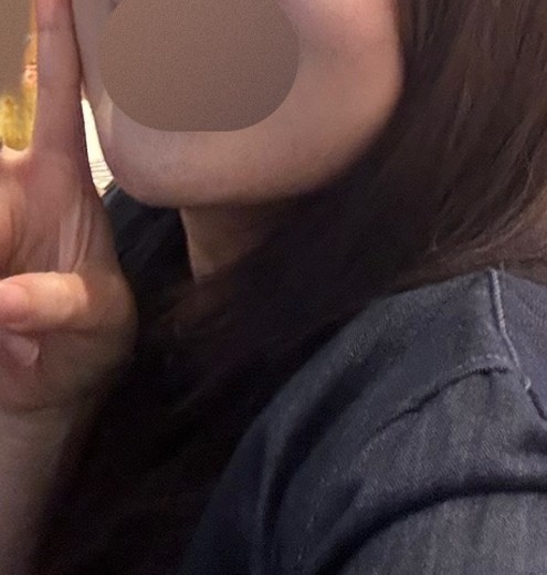 after photo: 인모드리프팅, 윤곽주사, 사각턱보톡스