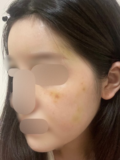 after photo: リジュランヒーラー, スキンボトックス