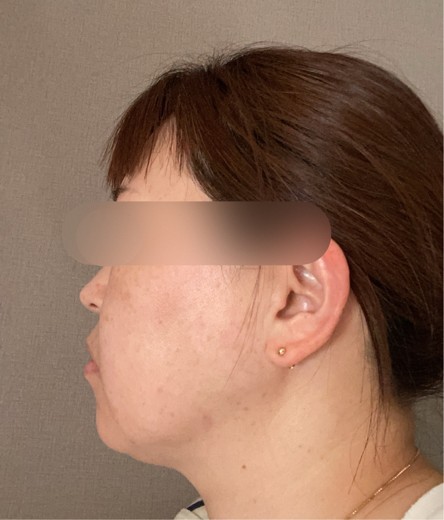 before photo: 脂肪溶解注射(腕), 脂肪溶解注射(顔)