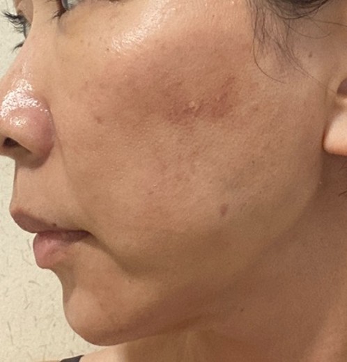 before photo: ルメッカ