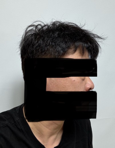 before photo: 눈밑지방재배치