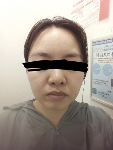 before photo: ダーマペン