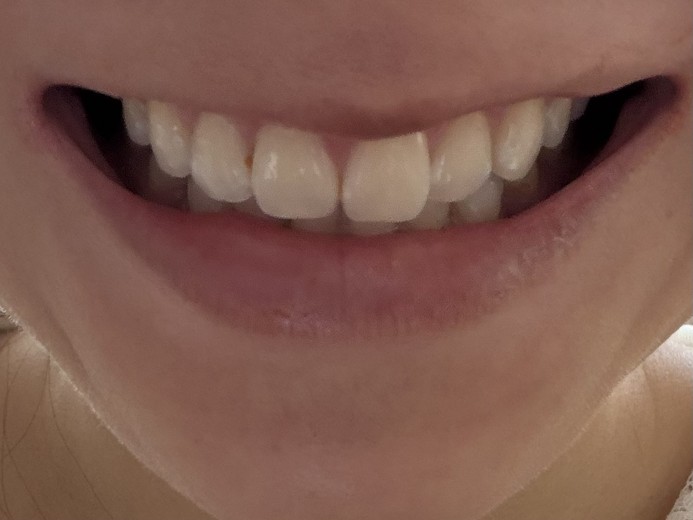 after photo: ホワイトニング