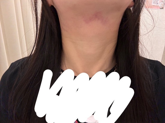 after photo: インモード