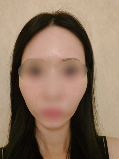 after photo: IPL(光/フォト治療)