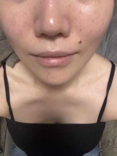 after photo: ジュベルック(Juvelook)