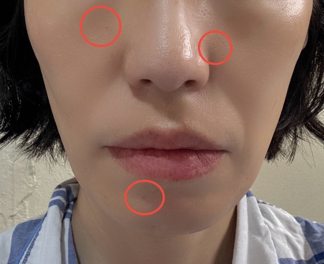 after photo: IPL(光/フォト治療)