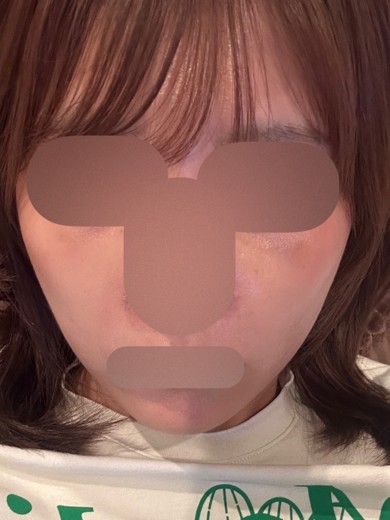 after photo: 美容注射・点滴
