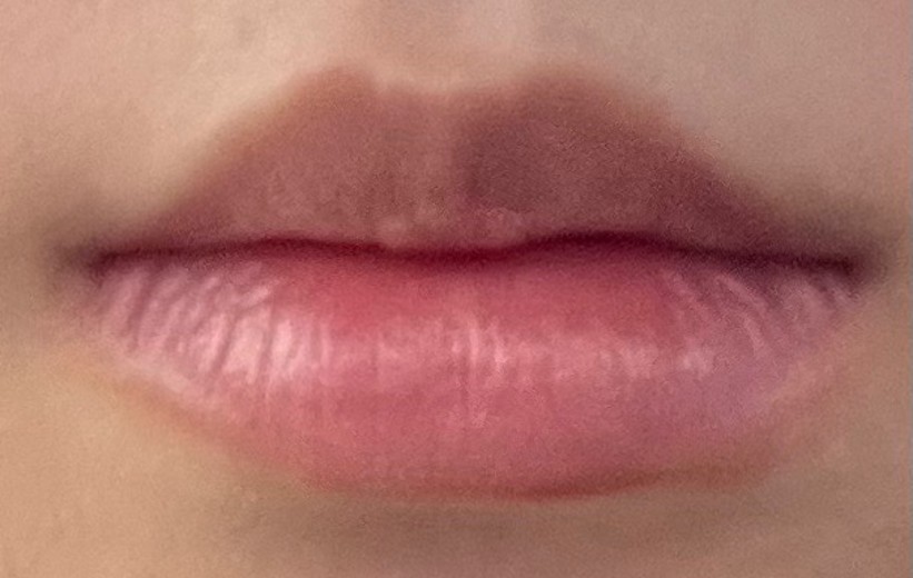 before photo: 입꼬리필러, 입꼬리보톡스, 입술필러