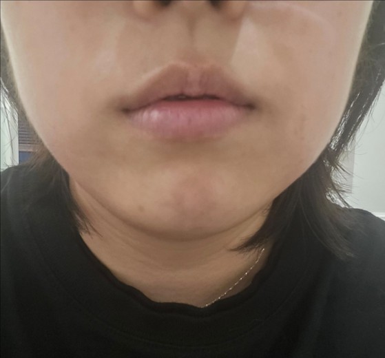 after photo: 사각턱보톡스, 튠라이너