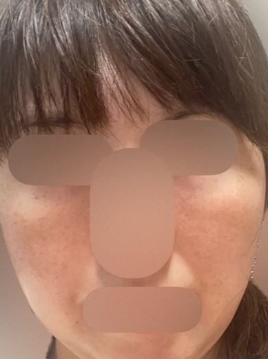 after photo: ミラノリピール