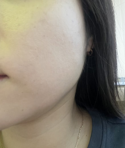 before photo: 사각턱보톡스