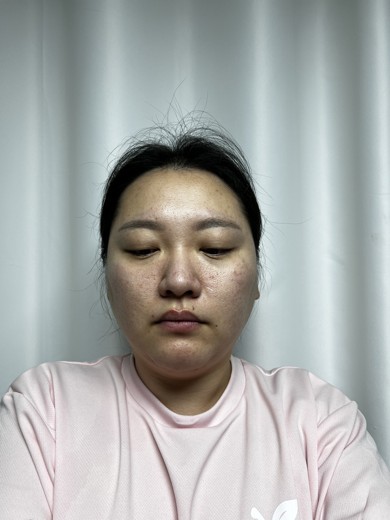 before photo: 점제거시술, V레이저