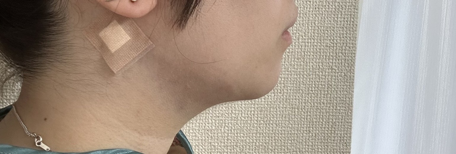 after photo: 脂肪吸引(顎下)