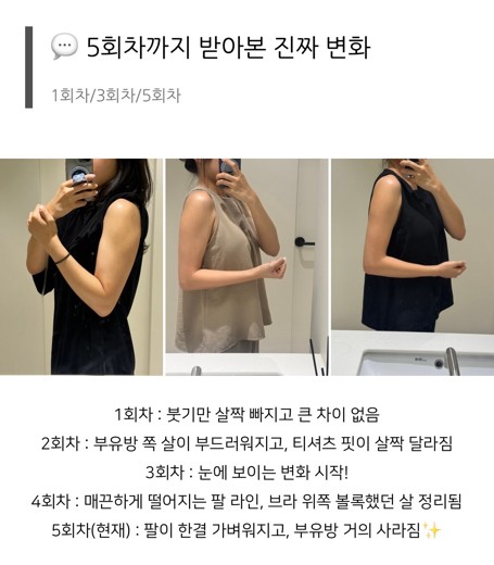 after photo: 팔지방분해주사