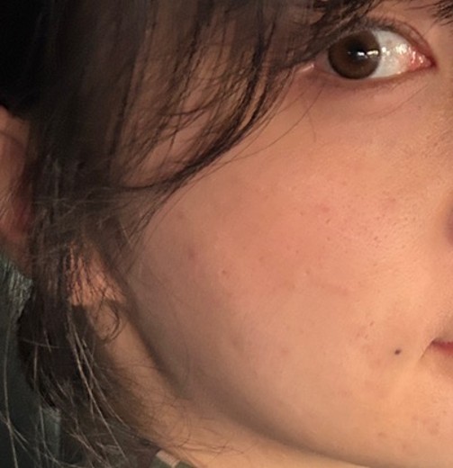 before photo: 보조개성형