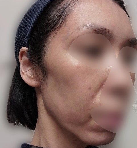 before photo: IPL(光/フォト治療)