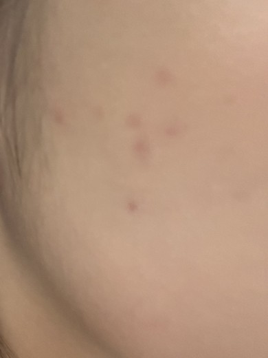 before photo: 피코토닝, 레이저토닝, 제네시스