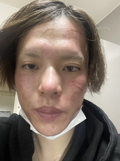 after photo: ダーマペン