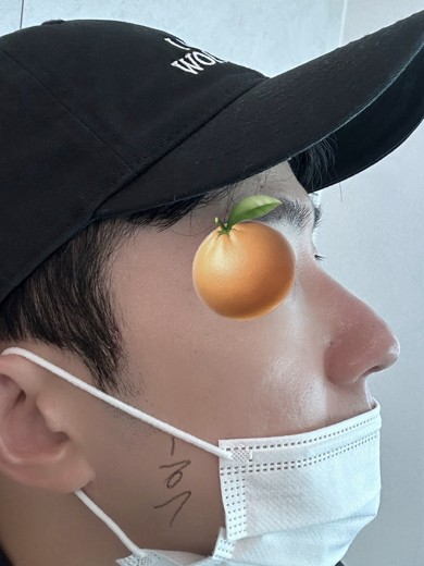 after photo: 콧대(보형물), 코끝(자가연골), 비후성비염수술