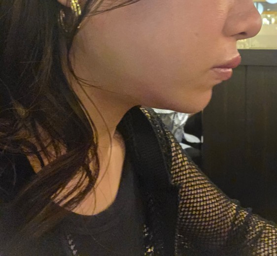 before photo: あごヒアルロン酸