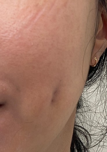 after photo: 보조개성형