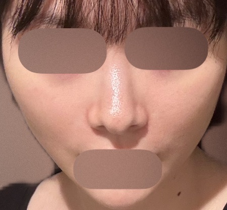 エレクトロポレーション【再来OK】 | ライズワン美容皮膚科クリニック