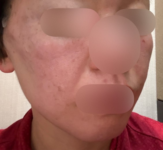 after photo: 糸リフト