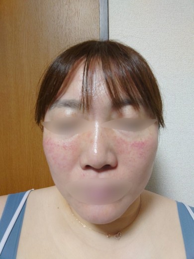 after photo: ダーマペン
