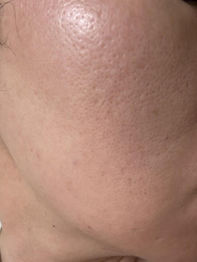 before photo: IPL(光/フォト治療)