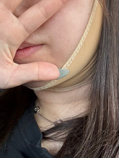 after photo: 脂肪吸引注射