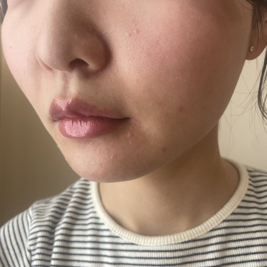 after photo: ダーマペン