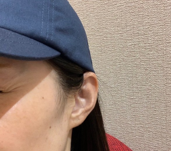 before photo: 目尻ボトックス