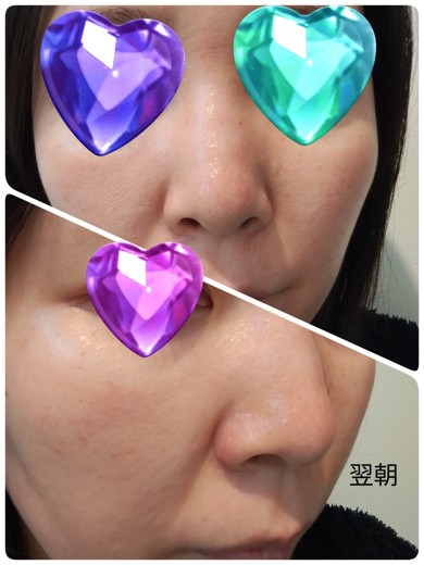 after photo: ピーリング, ダーマペン