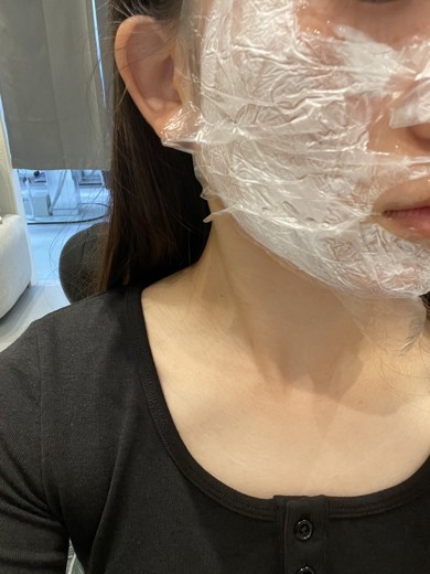 before photo: PDTレーザー, フラクショナルレーザー, レーザートーニング, ほくろ除去(レーザー)