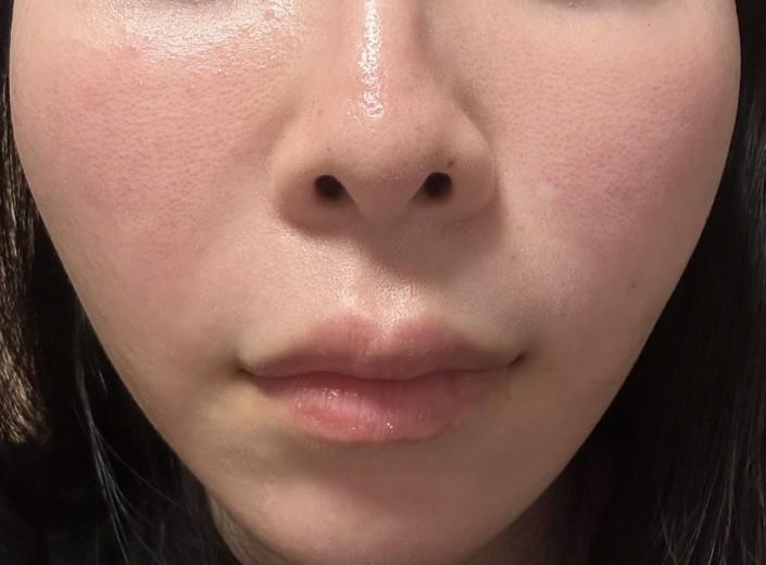 after photo: IPL(光/フォト治療)