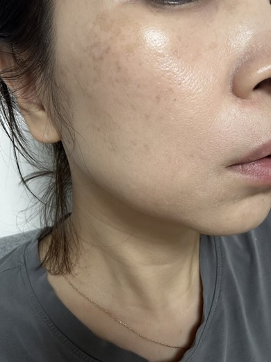 before photo: 미간보톡스, 이마주름보톡스