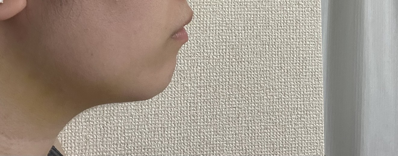 after photo: 脂肪吸引(顎下)