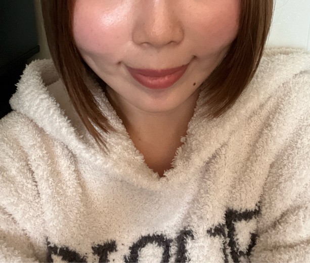 after photo: 脂肪溶解注射(顔)