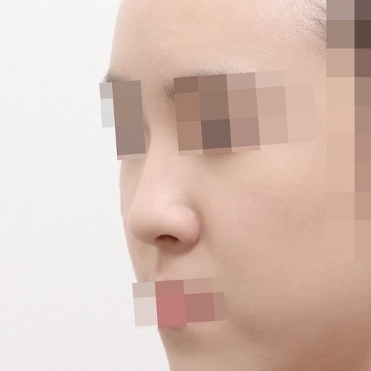before photo: 콧대(자가조직), 콧대(보형물)